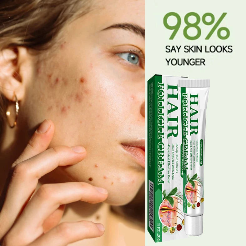 Clear Acne Cream
