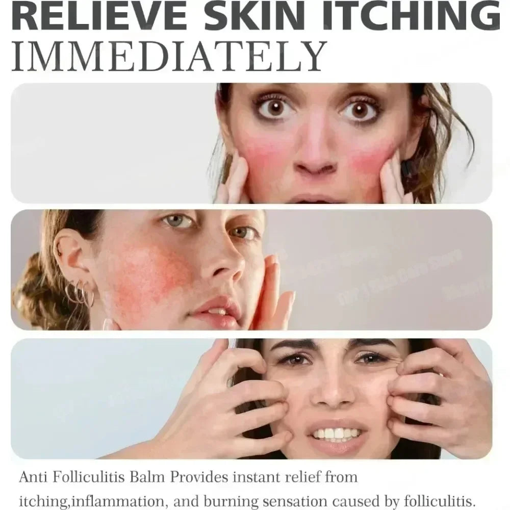 Clear Acne Cream