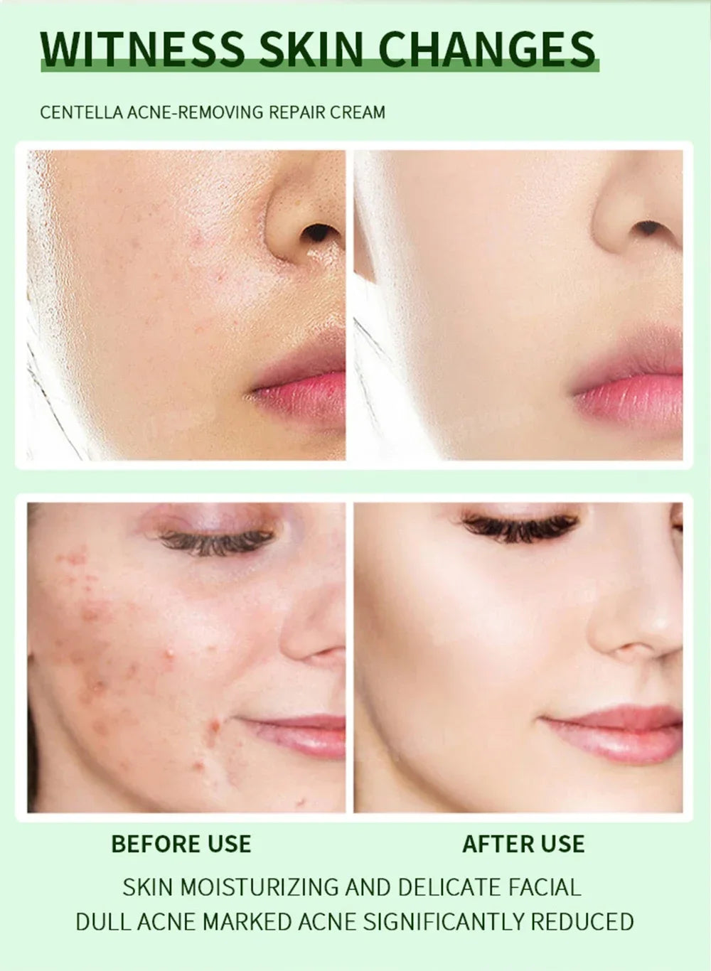 Clear Acne Cream