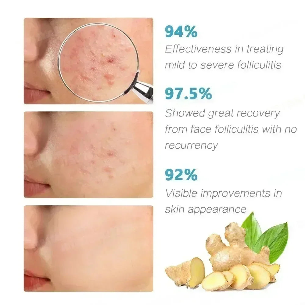 Clear Acne Cream