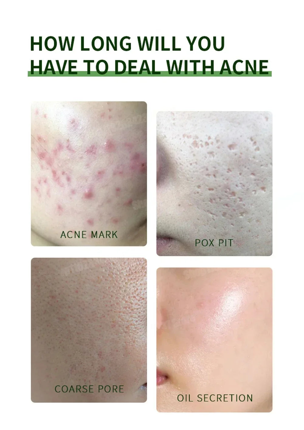 Clear Acne Cream