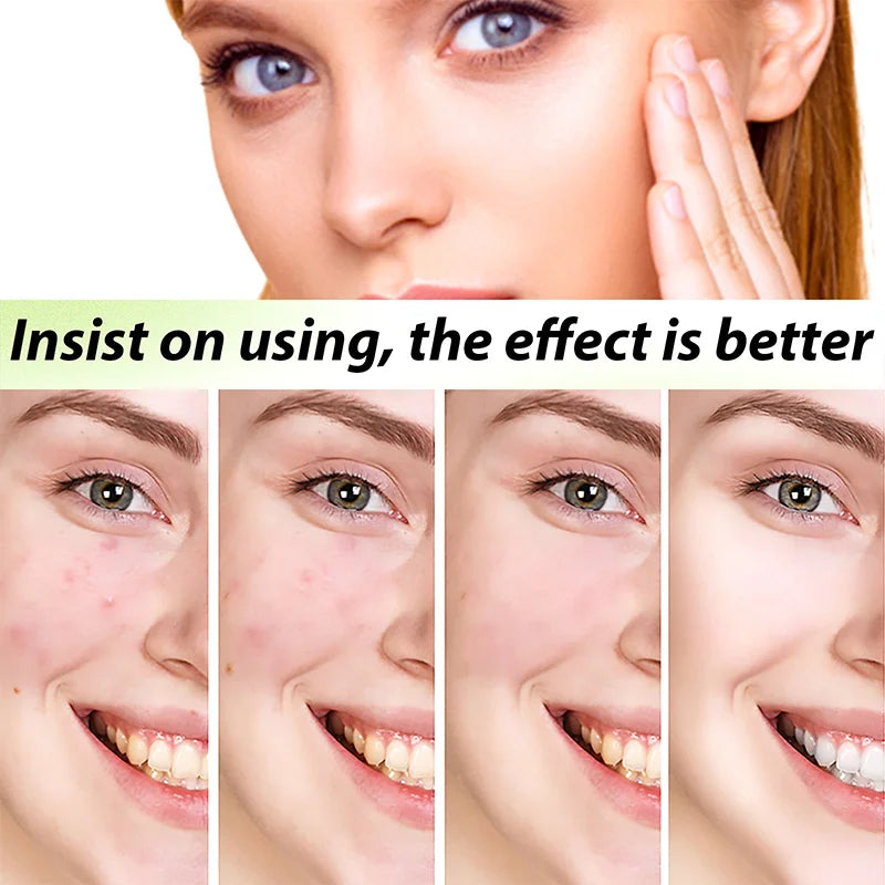 Clear Acne Cream