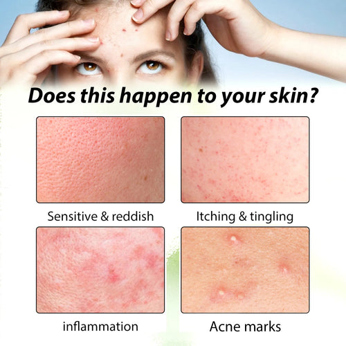 Clear Acne Cream